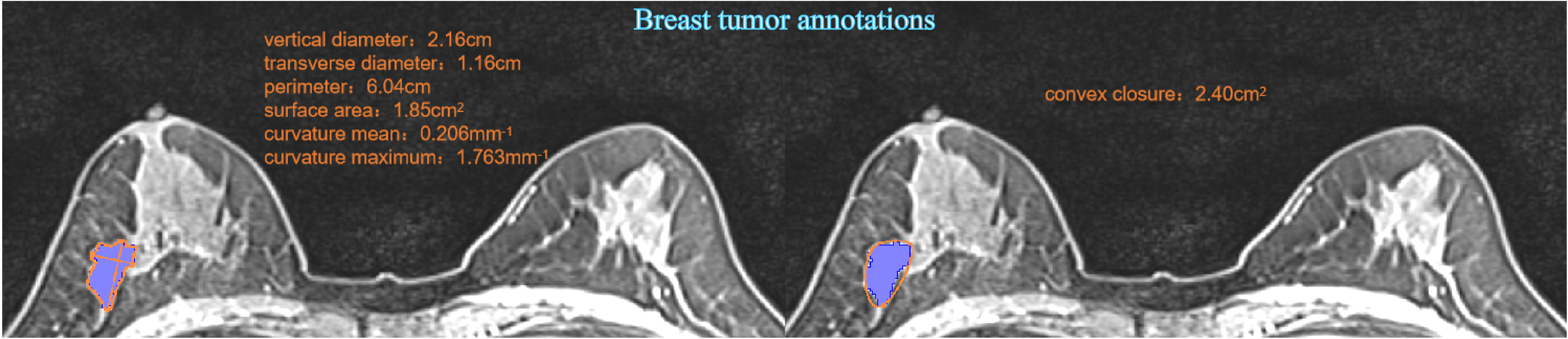 breast tumor annotations